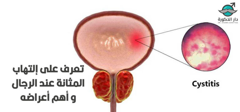 التهاب المثانة عند الرجال