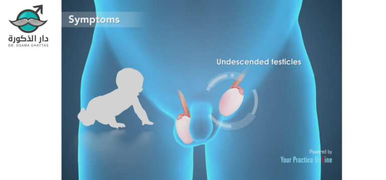 عملية الخصية المعلقة أسباب إجراءها والمخاطر المترتبة عليه