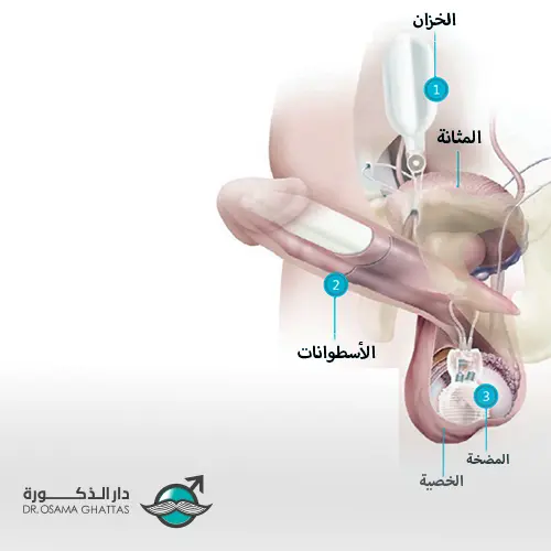 شكل الدعامة الهيدروليكية