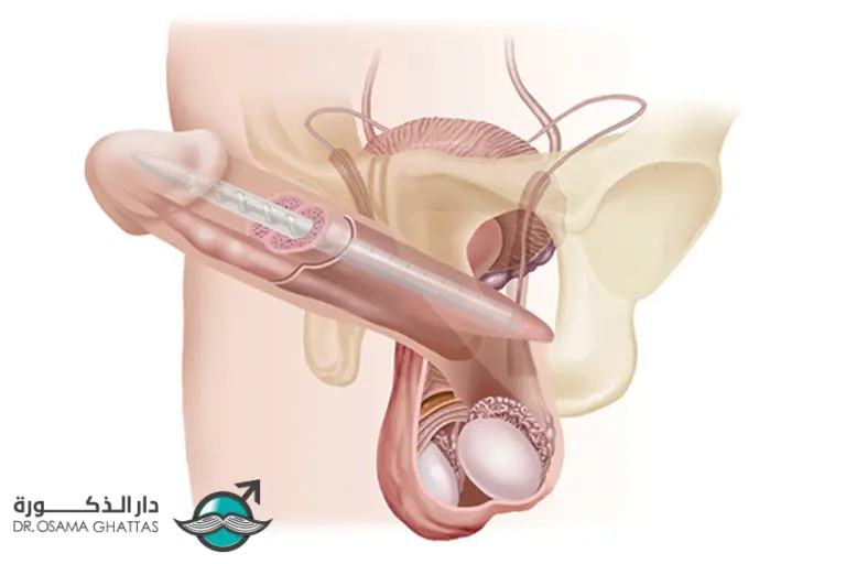 ما بعد زراعة الدعامة