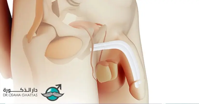 أضرار و مخاطر دعامات العضو الذكري