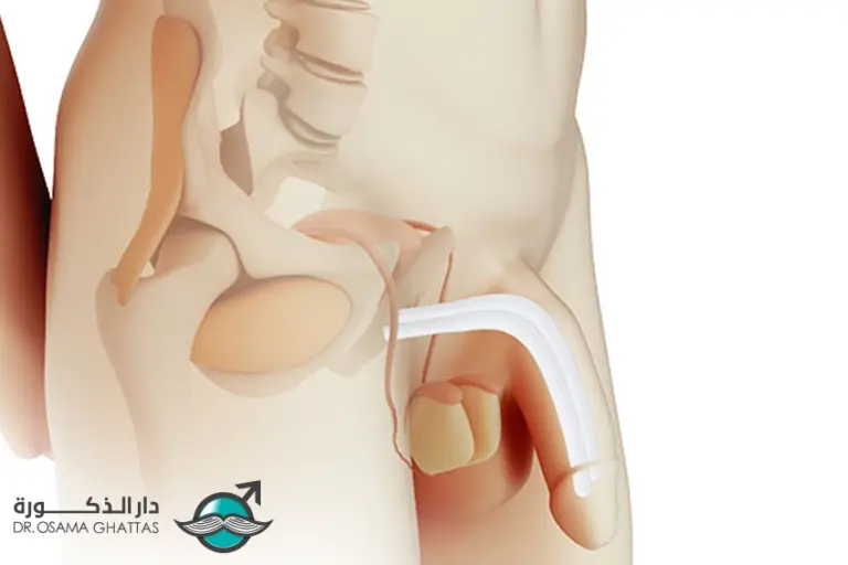 أضرار و مخاطر دعامات العضو الذكري